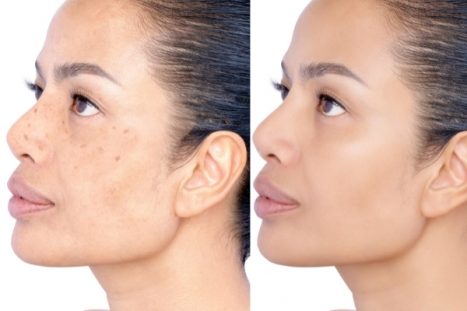 MANCHAS SOLARES Y MELASMA