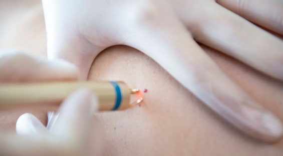 DESCUBRE CÓMO ELIMINAR PUNTOS DE RUBÍ CON LÁSER