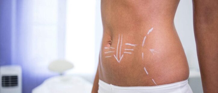 female-body-with-drawing-arrows-abdomen-liposuction-cellulite-removal-scaled-e1715342572381-1024×440 Taller Teórico Práctico de Diagnóstico Corporal