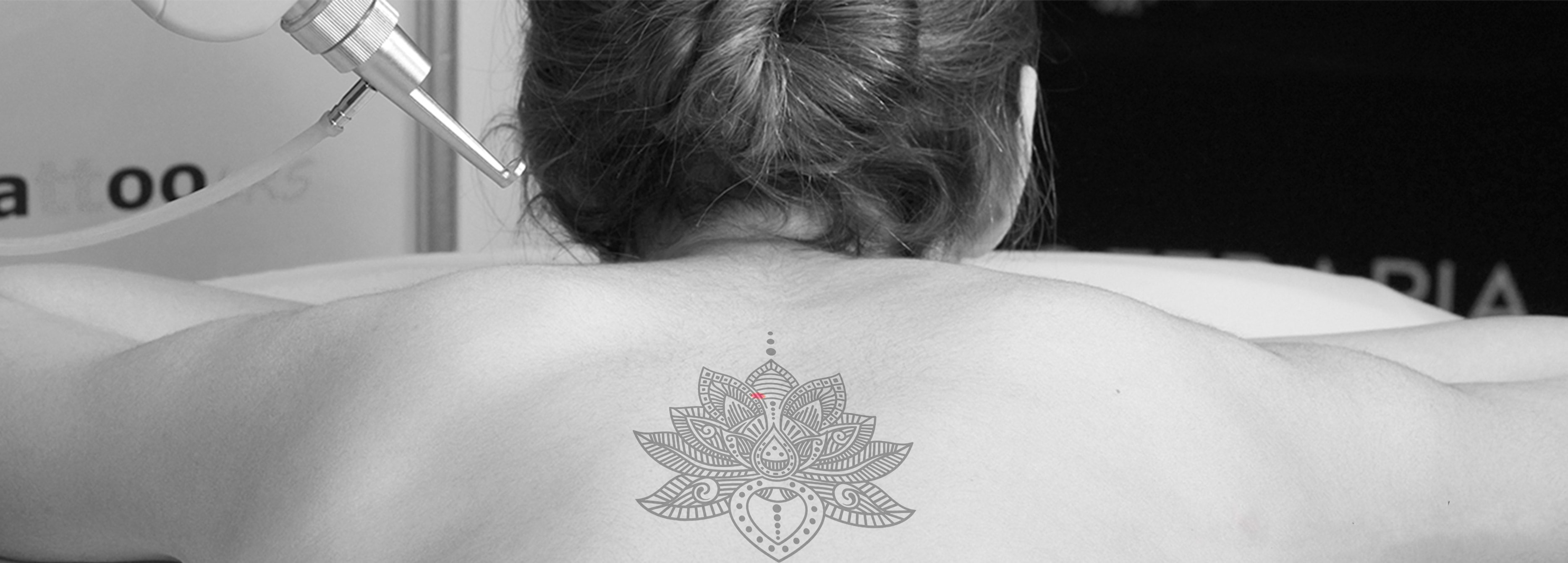 Eliminacion-de-tatuajes-tattoo-LRS-min