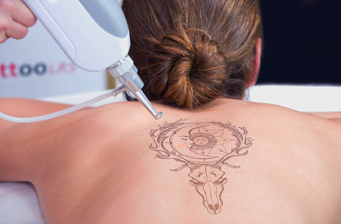 Eliminación de tattoos - Aparatología Estética Laserluz