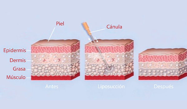 Láser CO2: ablación puntual con depósito térmico en epidermis y dermis.
