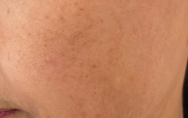 Antes: discromías y manchas faciales en mejilla.