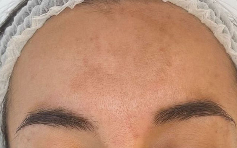 Antes: hiperpigmentación difusa en frente.