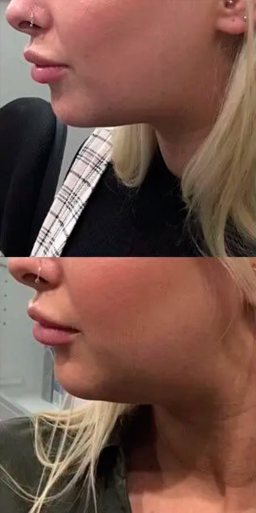 Antes: discromías y manchas faciales en mejilla.