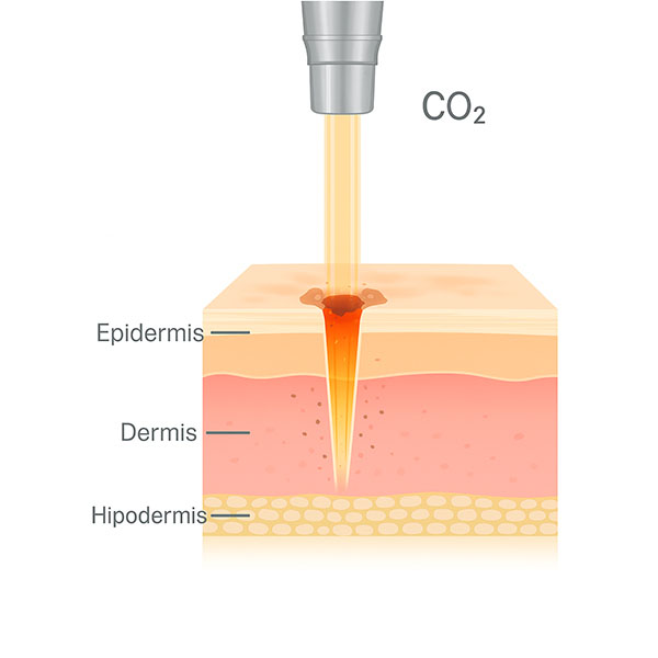Láser CO2: ablación puntual con depósito térmico en epidermis y dermis.