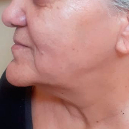 Después: piel más tensa y luminosa, arrugas suavizadas y contorno mandibular más definido.