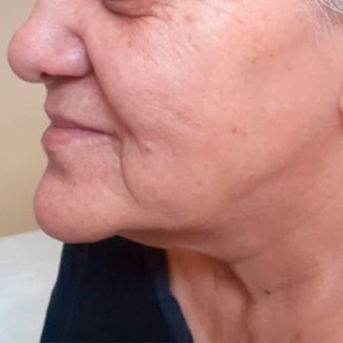 Antes: arrugas finas, flacidez leve y tono apagado en mejilla y línea mandibular.