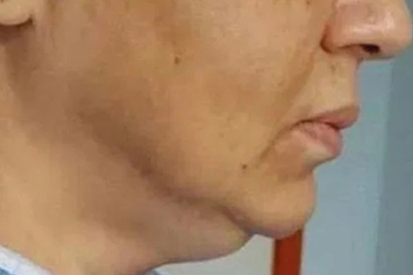 Antes: discromías y manchas faciales en mejilla.
