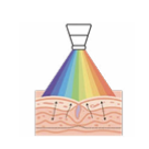 Láser CO2: ablación puntual con depósito térmico en epidermis y dermis.
