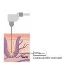 Láser CO2: ablación puntual con depósito térmico en epidermis y dermis.