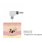 Láser CO2: ablación puntual con depósito térmico en epidermis y dermis.