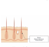 Láser CO2: ablación puntual con depósito térmico en epidermis y dermis.