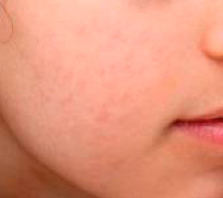 antes y después láser tulio 1927 nm para acné y cicatrices en mejilla