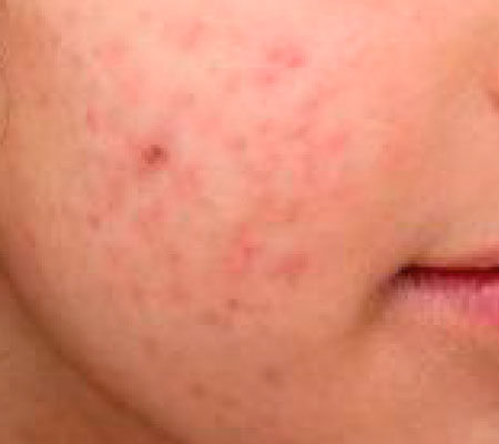 antes y después láser tulio 1927 nm para acné y cicatrices en mejilla