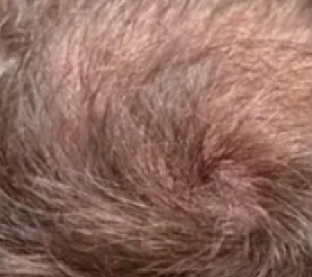 antes y después láser tulio 1927 nm para estimulación capilar y densidad del cabello