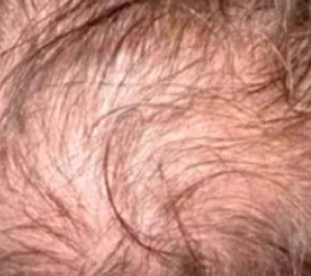 antes y después láser tulio 1927 nm para estimulación capilar y densidad del cabello