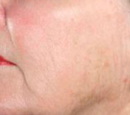 antes y después láser tulio 1927 nm para manchas solares y discromías faciales