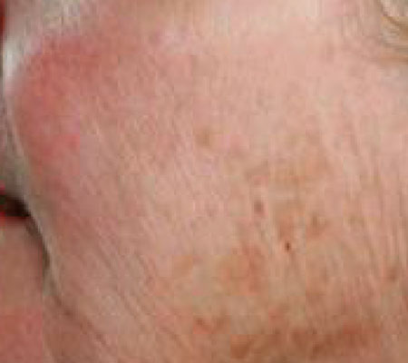 antes y después láser tulio 1927 nm para manchas solares y discromías faciales