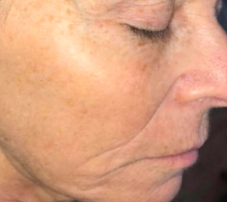 Después: tono más homogéneo tras tratamiento con CO2 fraccionado