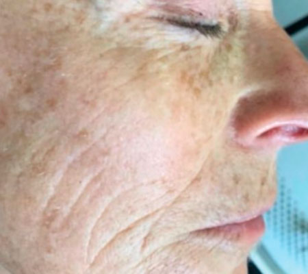 antes y después láser tulio 1927 nm para fotoenvejecimiento y arrugas finas