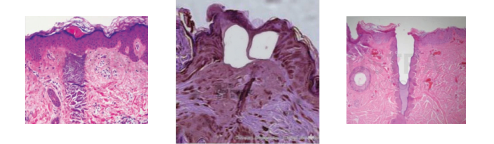 CO2 fraccionado: columnas térmicas que estimulan remodelado de colágeno.