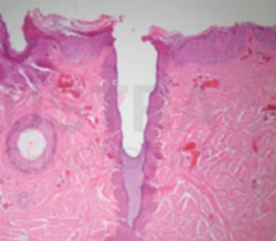 CO2 fraccionado: columnas térmicas que estimulan remodelado de colágeno.