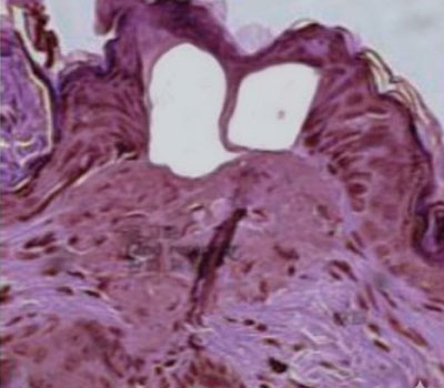 CO2 fraccionado: columnas térmicas que estimulan remodelado de colágeno.