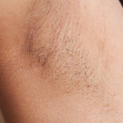 Fotodepilación médica