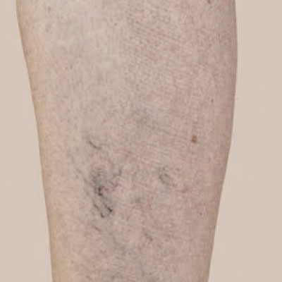 Tratamiento de lesiones vasculares