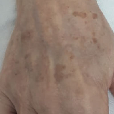 Tratamiento de lesiones pigmentarias