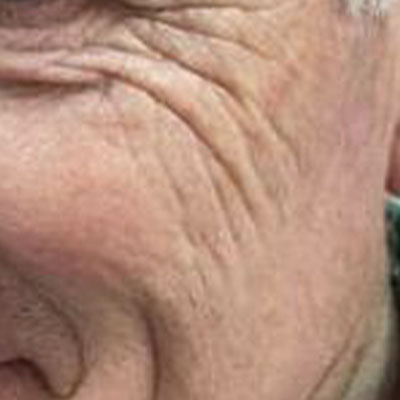 Rejuvenecimiento no ablativo