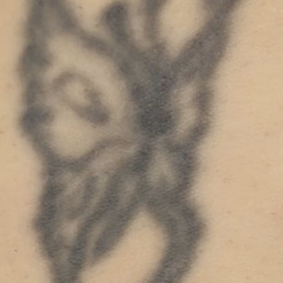 Tratamiento de tatuajes