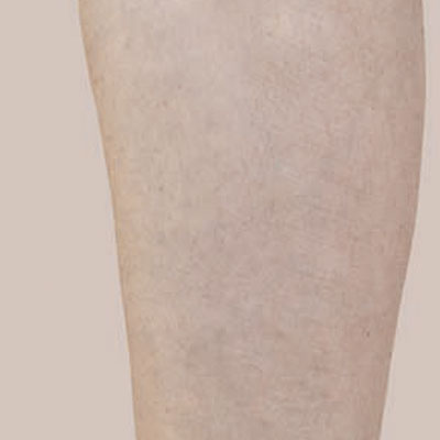 Tratamiento de lesiones vasculares