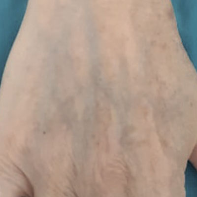 Tratamiento de lesiones pigmentarias