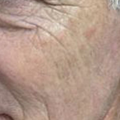 Rejuvenecimiento no ablativo