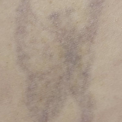 Tratamiento de tatuajes